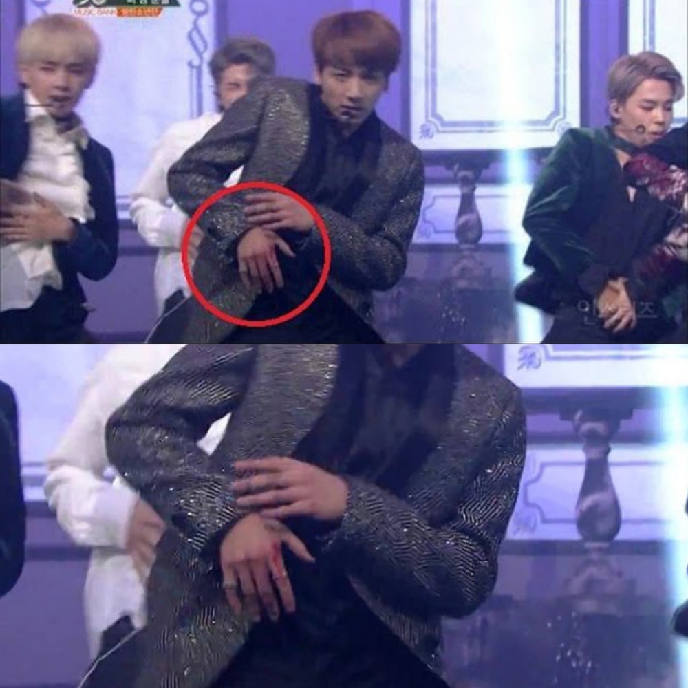 K-Pop idols who still continue their performance despite being injured 