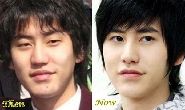 Kyuhyun plastic surgery