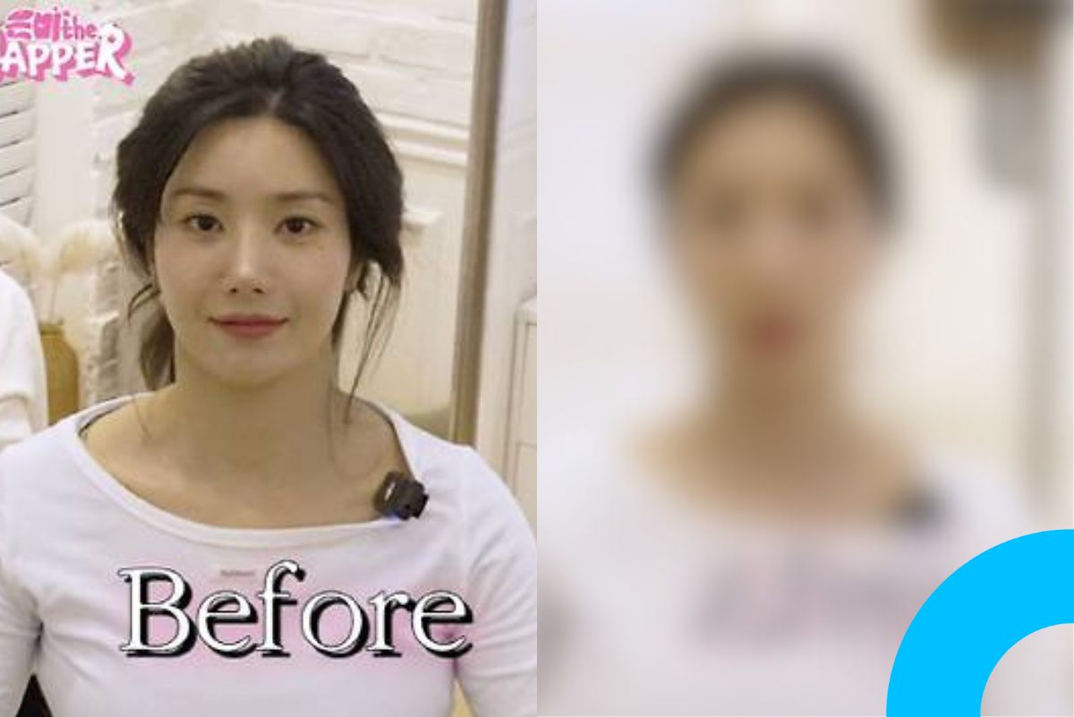 Kwon Eun-bi Reveals Before-and-After Treatment Photos thumbnail