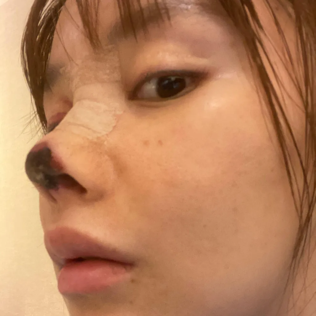 gao-liu-cosmetic-surgery-accident