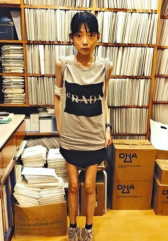 connie ng weight lossAnorexia-Prada-Library-Thin.