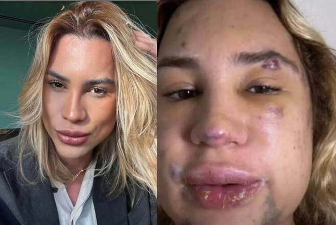 people-One person-A-Split image-A-Before and after cosmetic procedure-A-Plastic surgery results-B-Swelling and bruising-C-Blonde hair