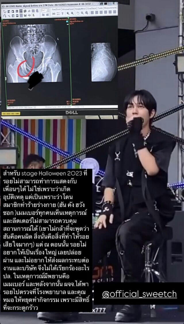 people-1-person on stage-A-X-ray image-B-Thai text overlay-C