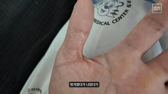people-0-hand-A-skin-condition-B-thumb-base-C-medical-context