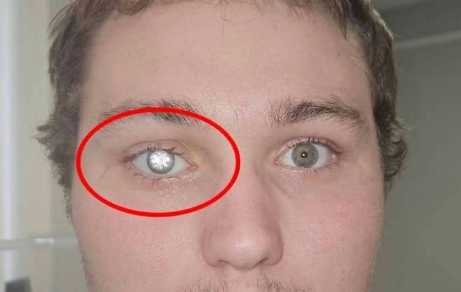 people-man-A-close-up-A-eyes-A-cataract-B-red circle-C