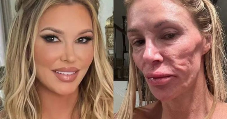 brandi glanville recovery