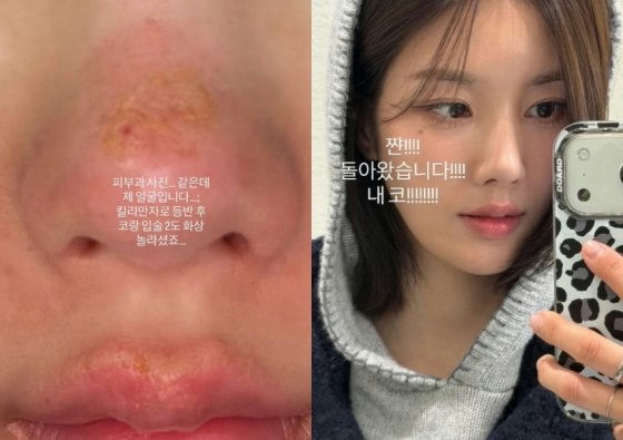 people-A-woman with skin irritation on nose and mouth area-A-woman showing clear skin and holding a phone-A-selfie-A-before and after-A-Korean text overlay