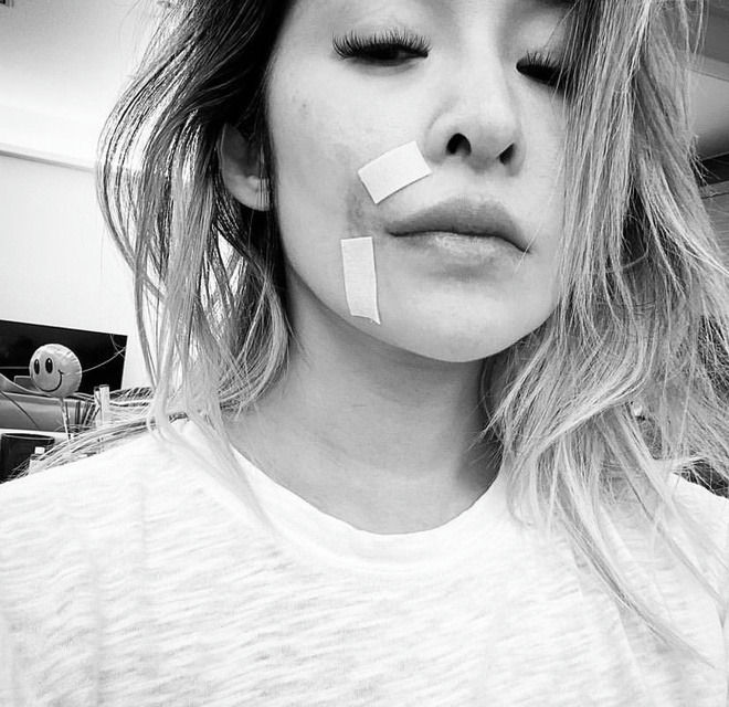 people-CL-gisele-oliveria-bandages-A-bruising-A-selfie