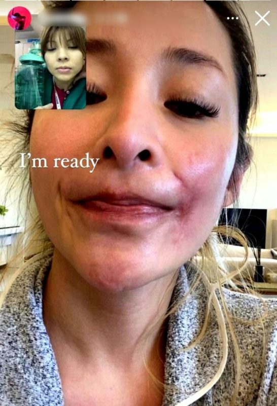 people-Sarah Stage-video call-redness around mouth-false eyelashes-textured sweater