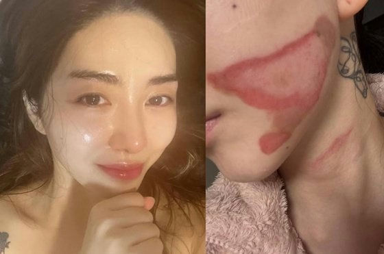 kwon mina skin procedure burn