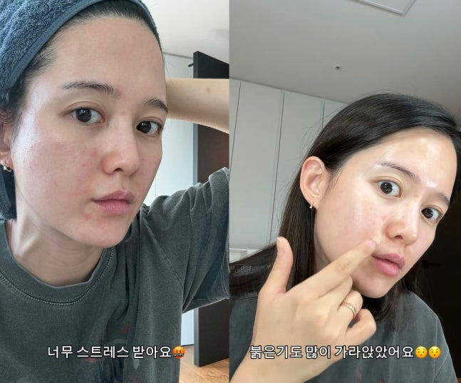 Nam Bo Ra pregnancy skin changes