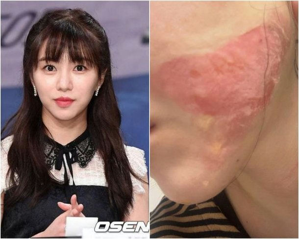 people-Kim So-eun-A-before and after-A-skin injury-B-celebrity-C-burn-like redness