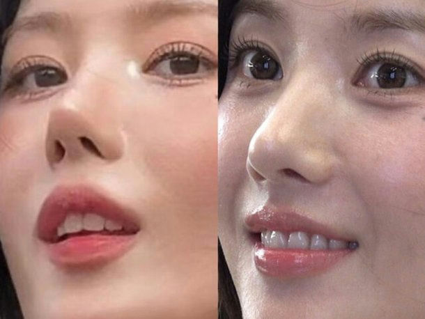 kwon eun bi nose line change
