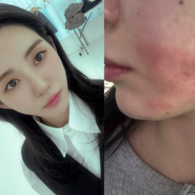 Kwon Mina Reveals Struggles After Shrink Laser Burn Injury and Medical Dispute
