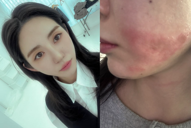 Kwon Mina burn injury